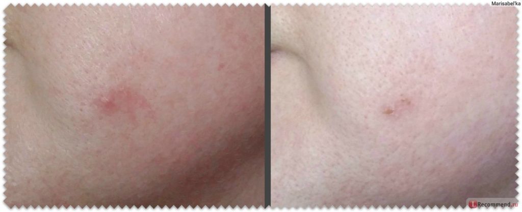 Tratamiento del acné con tintura de caléndula: fotos antes y después.